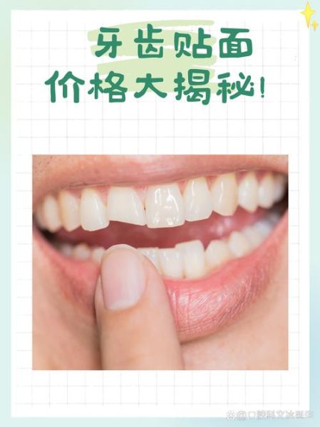 牙齿贴面能用多久_牙齿贴面价格贵吗